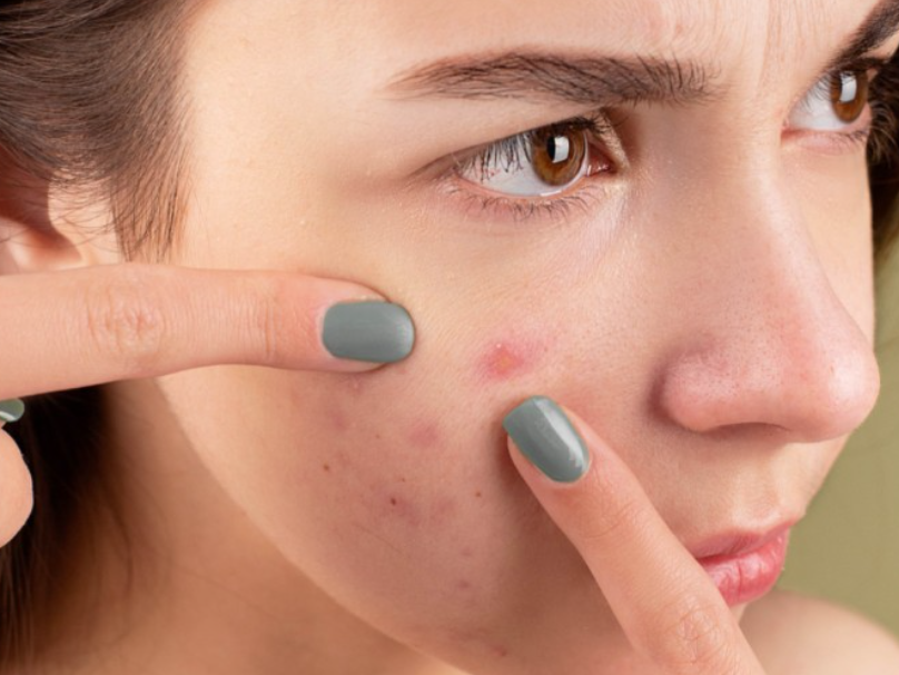 스티바에이크림 효과