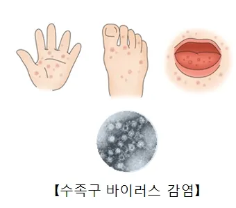 수족구병 증상과 예방 조치 방법 모음_2