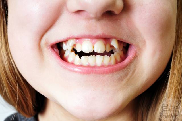 부모 치아 유전