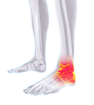 왼쪽 발목 통증 