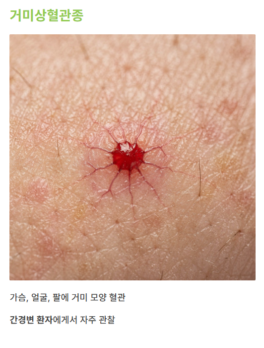 간질환과 피부병 증상의 관계