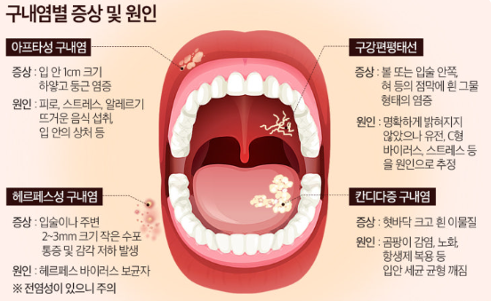 구내염 급증 원인 관련 사진