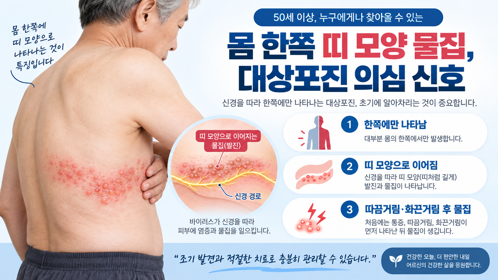 몸 한쪽 신경을 따라 띠 모양으로 나타나는 대상포진 발진과 물집을 설명하는 이미지