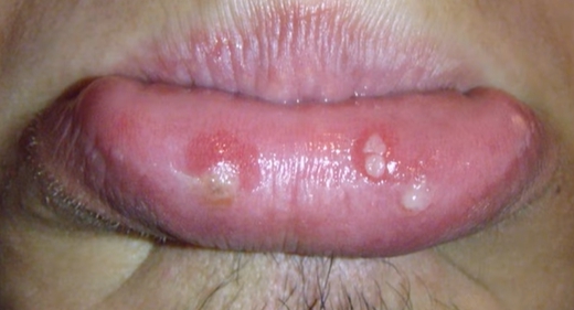 입술 수포 원인