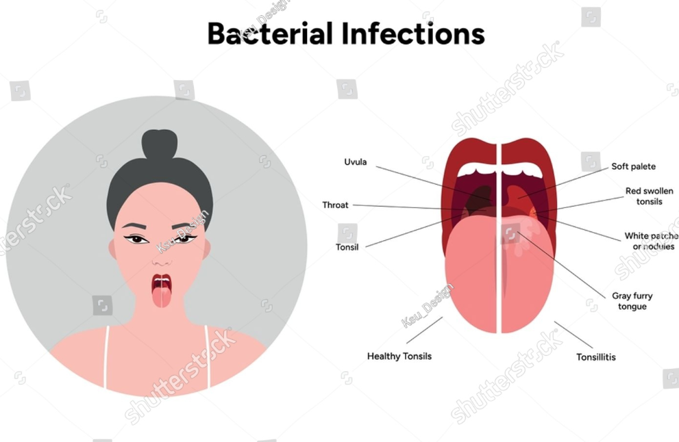 설암과 혀 절제술