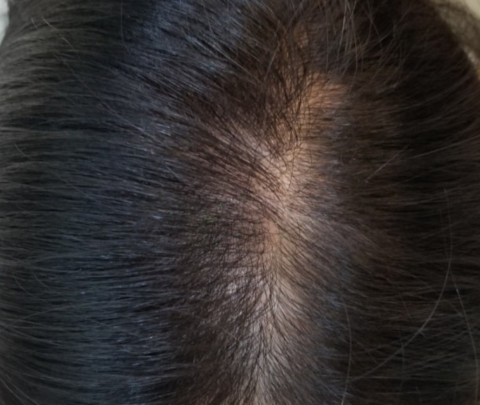 모발이식 3000모 비용 4000모 비용 부작용 과정