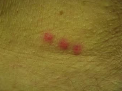 빈대 물린 자국