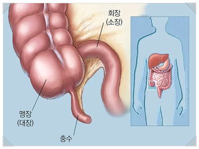 맹장염 초기증상
