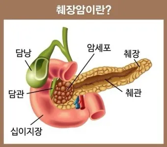 췌장암 초기 증상 췌장암 등통증 위치 검사_26