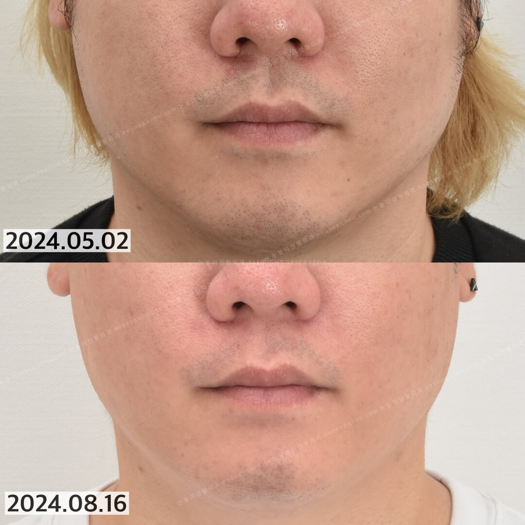 남자레이저제모