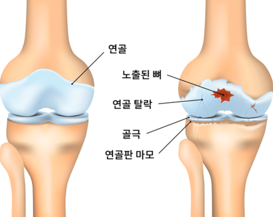 퇴행성-관절염-진행-과정