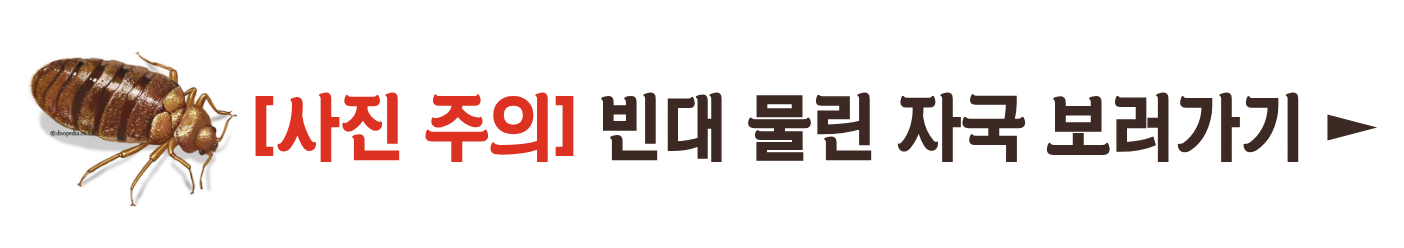빈대 확인법 빈대 물린 자국 빈대 퇴치(+2024)