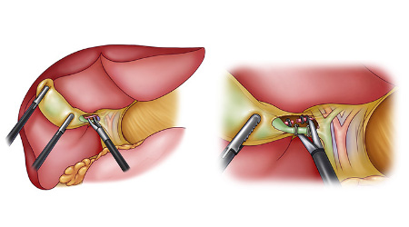 쓸개(담낭) 제거수술