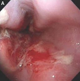 역류성 식도염 증상