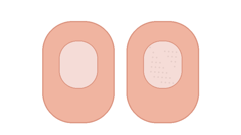 손톱 건선(조갑건선) 완전 정리: 손톱 패임&middot;들림&middot;두꺼워짐이 계속될 때 의심해야 하는 이유