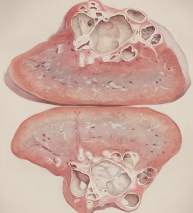 지방간 진단 기준 치료방법 합병증 예방