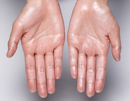 손에-땀이난-사진