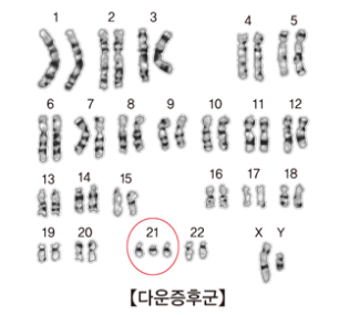 다운증후군