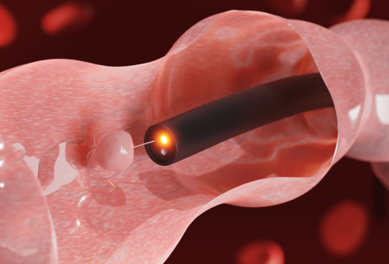 용종 제거 비용