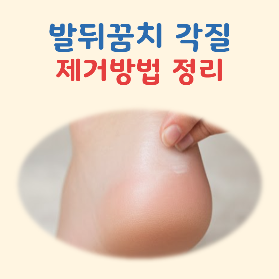 발뒤꿈치 각질제거방법 대표 이미지
