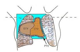 전산화 방사선 치료 계획