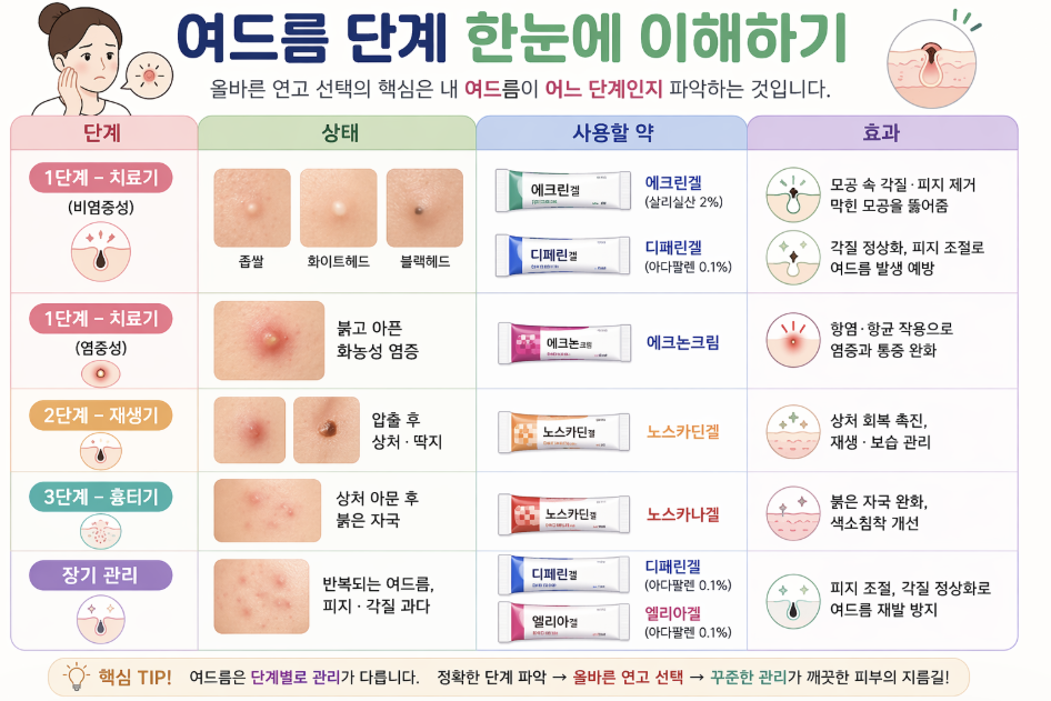 여드름 단계별 치료 방법 인포그래픽으로 좁쌀, 화농성, 흉터 단계에 따른 연고 추천(에크린겔, 디페린겔, 에크논크림, 노스카나겔)과 피부 관리 방법을 정리한 이미지
