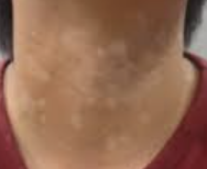 고지혈증 증상 10