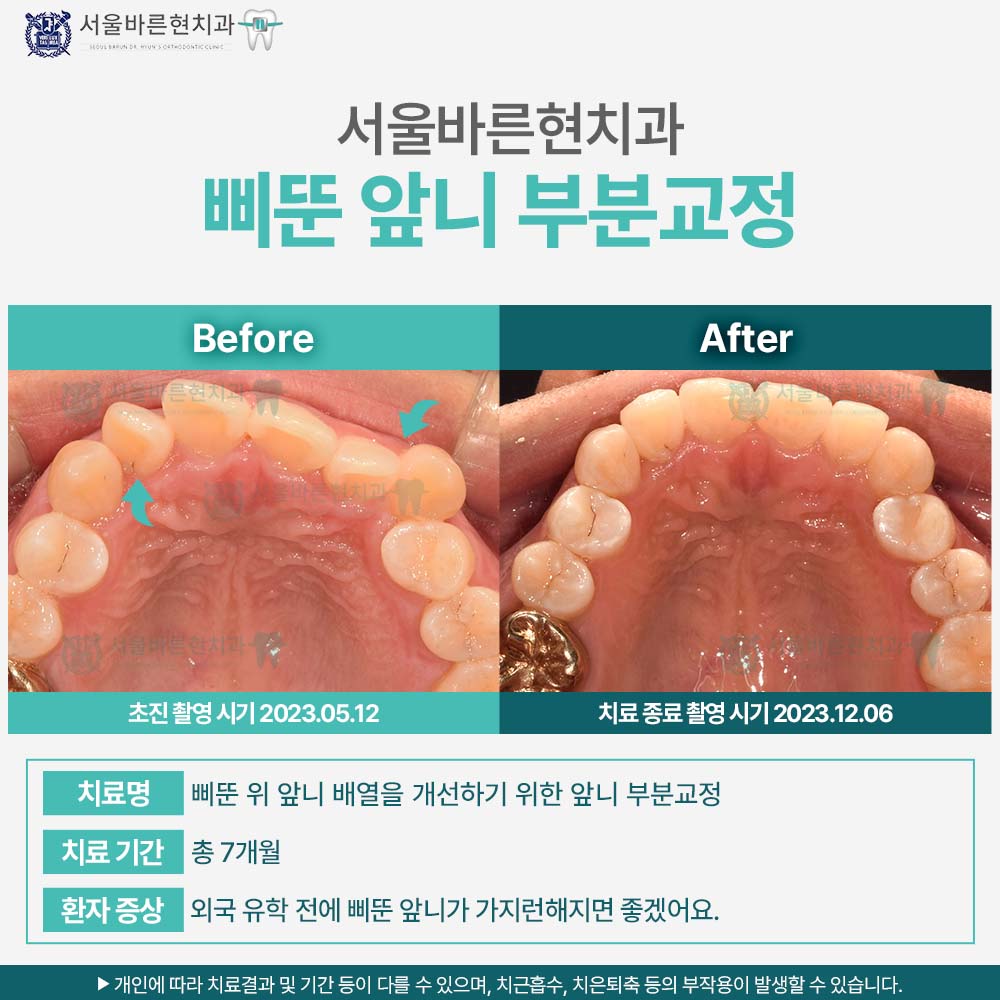 마린시티앞니교정