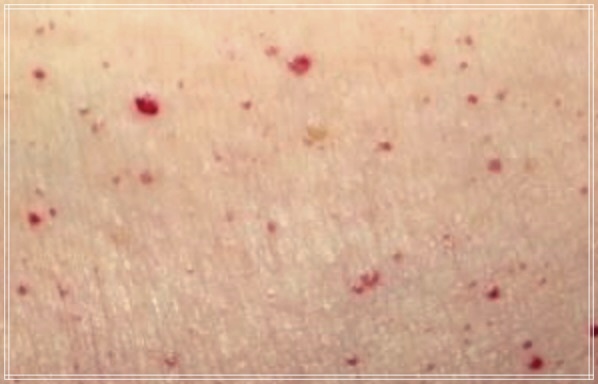 혈관종과 일반 종양의 차이점