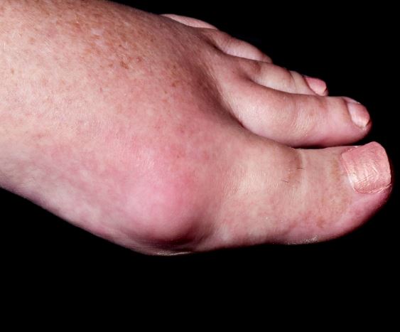 통풍-초기-증상