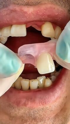 양쪽-이빨에-걸치게-작성된-가운데-이