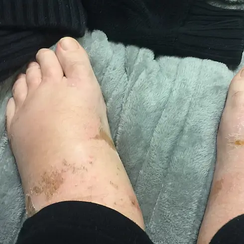 간 기능 이상 의심 증상 1: 부종