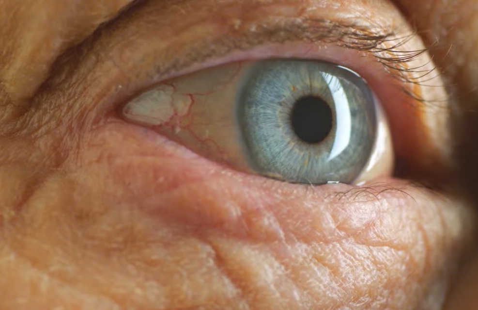 녹내장 초기증상