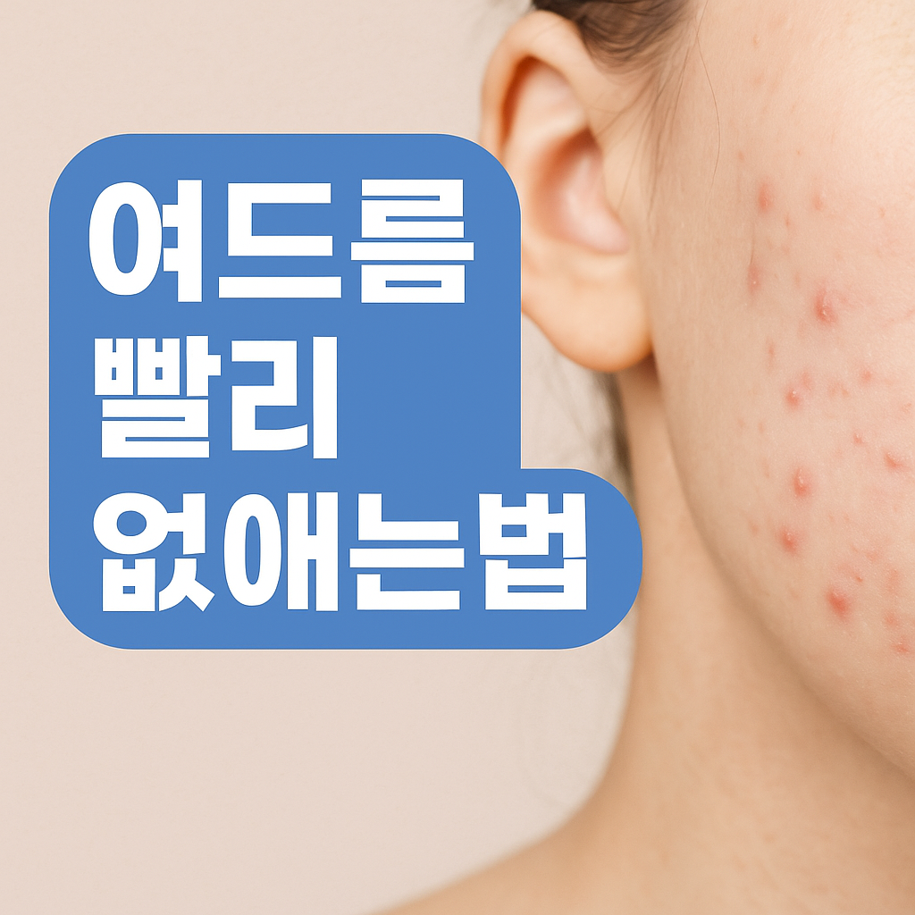 여드름 빨리 없애는법