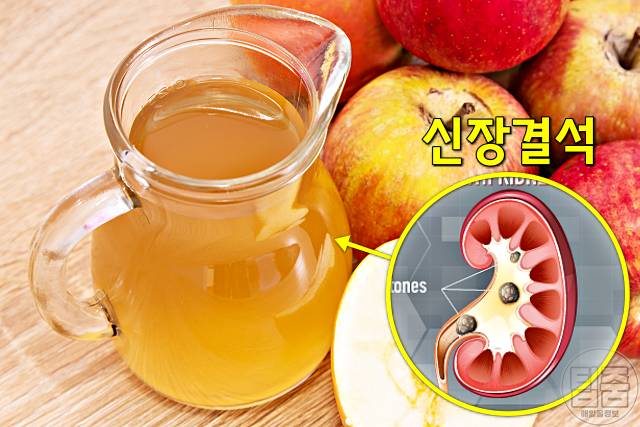 요로결석 녹이는 음식 사과식초 요로결석 좋은 음식
