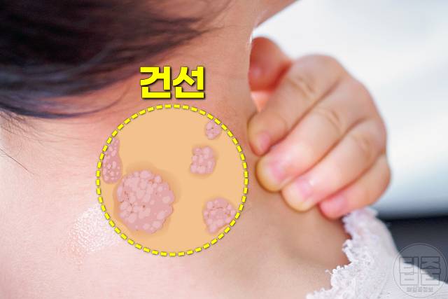 겨드랑이 까만색 착색 원인 건선 겨드랑이 까만 이유