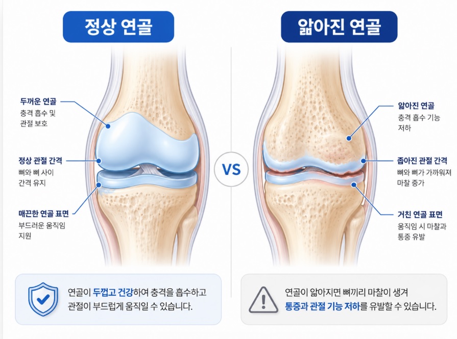 &lsquo;정상 연골과 닳아 얇아진 연골&rsquo;을 비교한 간결한 의학 정보형 일러스트.