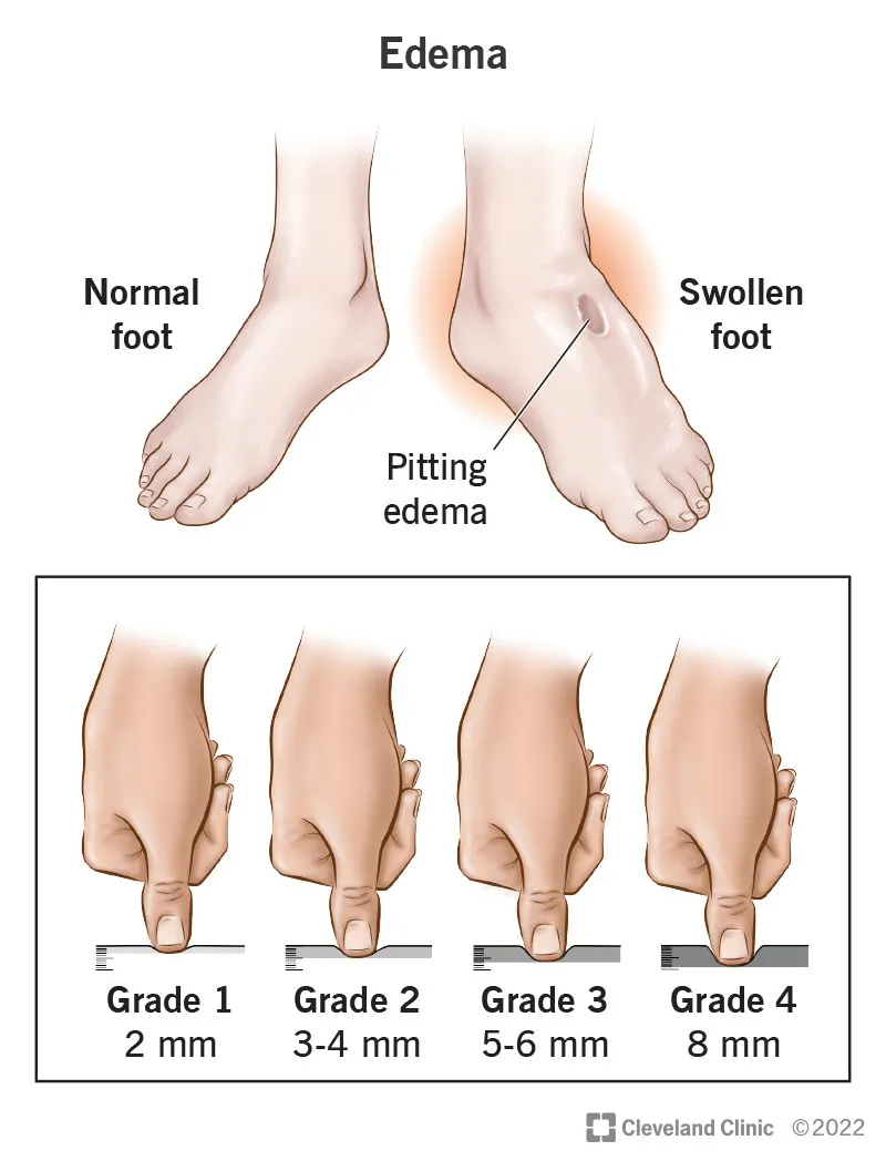 부종의 원인과 증상 5가지 개선방법 치료법_2
