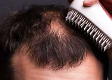 미녹시딜 부작용&amp;#44; 여자&amp;#44; 사용방법&amp;#44; 가격&amp;#44; 직구