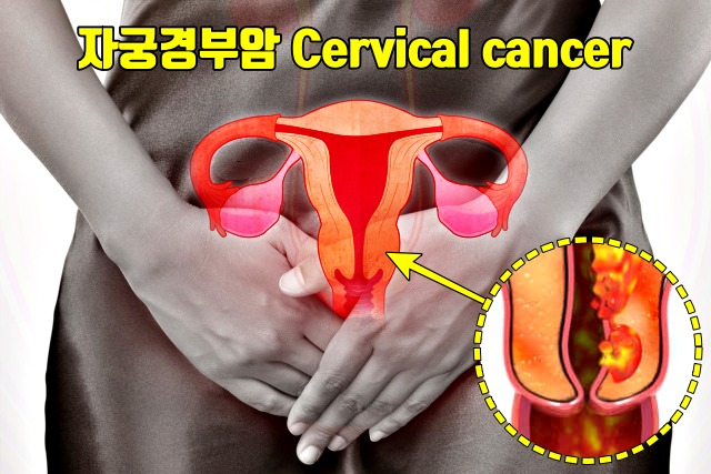 자궁암 증상 원인,자궁경부암 초기증상