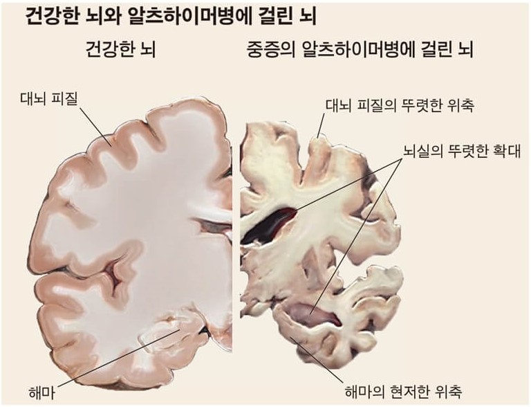 건강한 뇌와 알츠하이머병이 있는 뇌