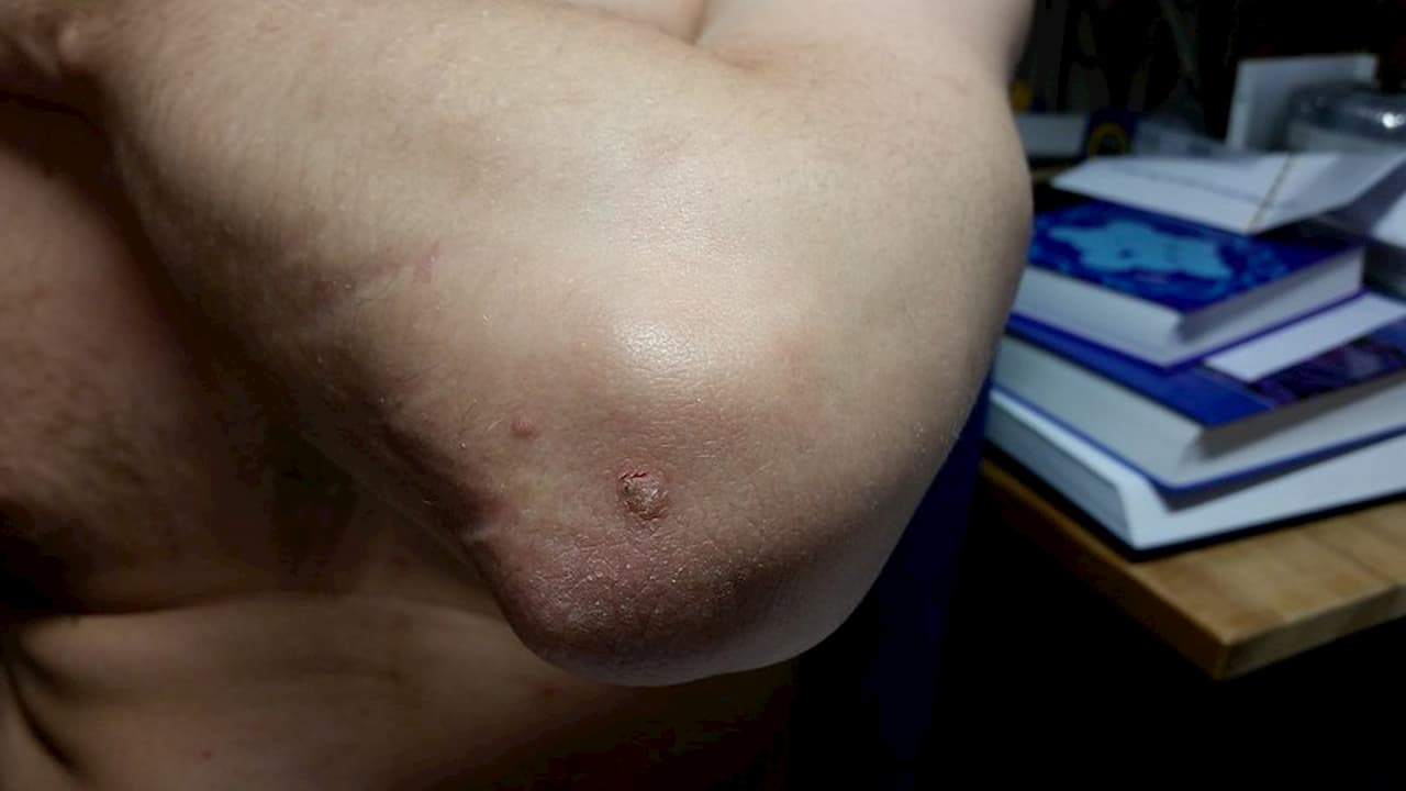 사마귀는 전염성이 있습니다