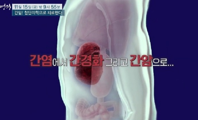 간염-간경화-간암