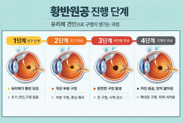 황반원공 원인과 망막 두께 관계 분석 관련 이미지