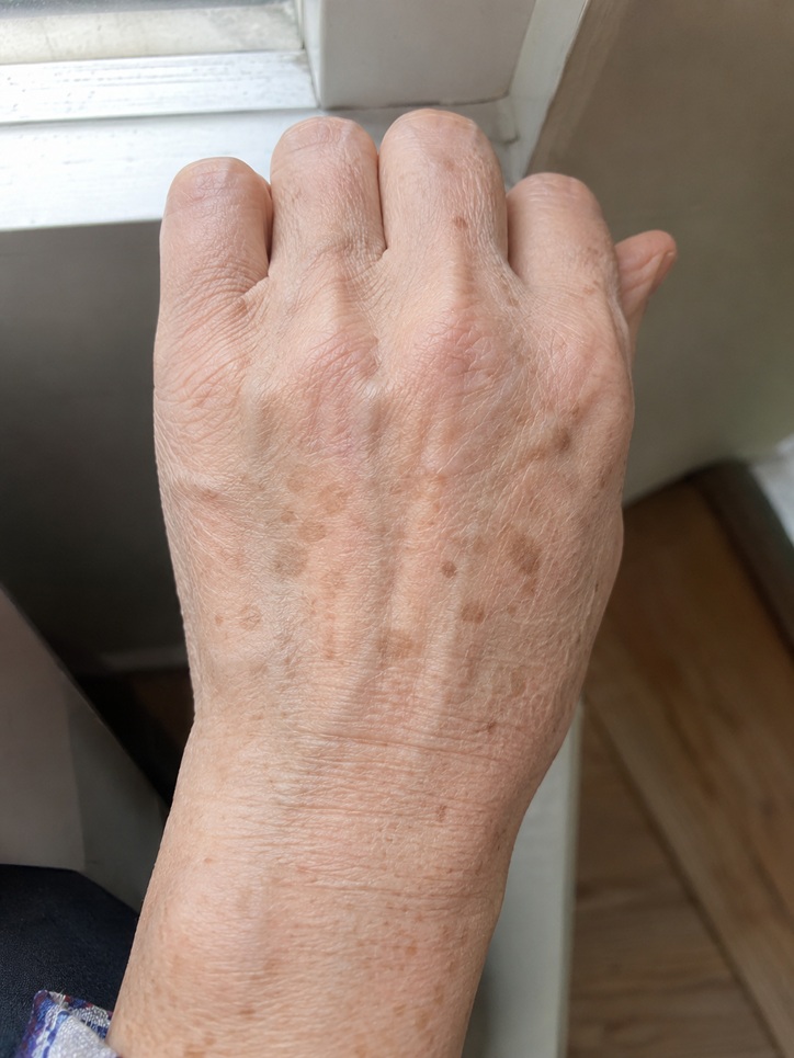 자연광이 비치는 창가에서 촬영한 손등의 연한 갈색 검버섯과 기미 잡티 피부 상태