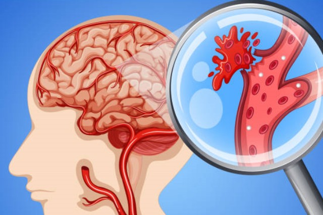 뇌혈관에 좋은 음식 뇌졸중에 좋은음식 콜레스테롤 수치 혈전에 좋은 음식, 건강 팁줌 매일꿀정보