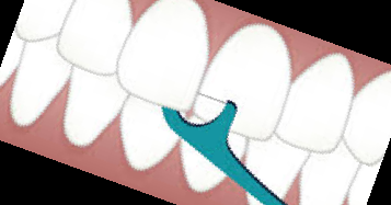 잇몸 내려앉음 치료