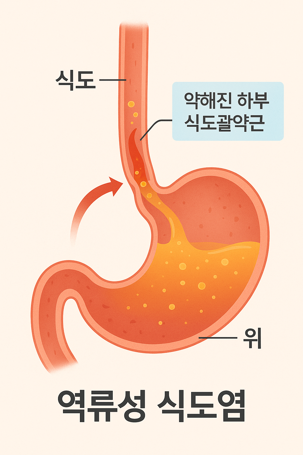 약해진 식도 괄약근 이미지