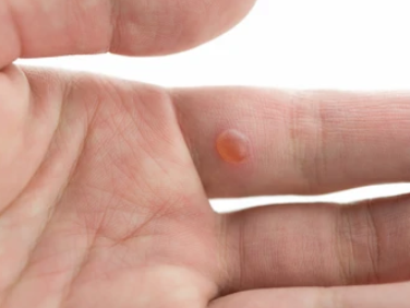 사마귀 제거방법