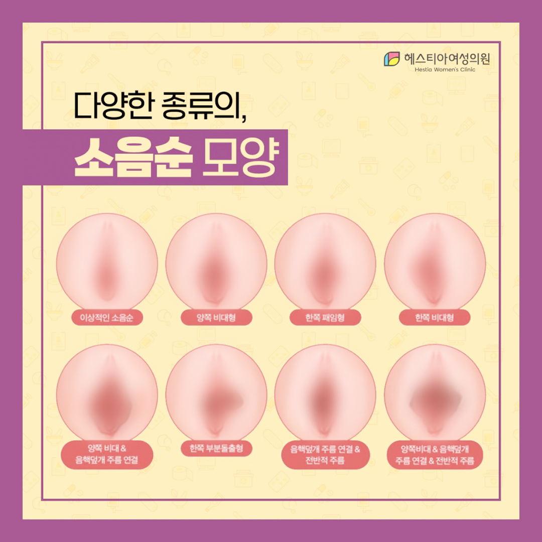 소음순 비대칭 말고도 이런 경우 소음순성형이 도움됩니다.